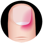 Infiammazioni del letto ungueale