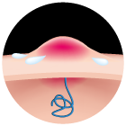 Infiammazioni ed ascessi delle ghiandole sudoripare